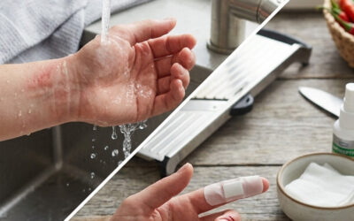 Urgences en cuisine : Le guide de survie face aux brûlures et coupures